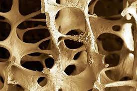 Everything You Need To Know About Osteoporosis